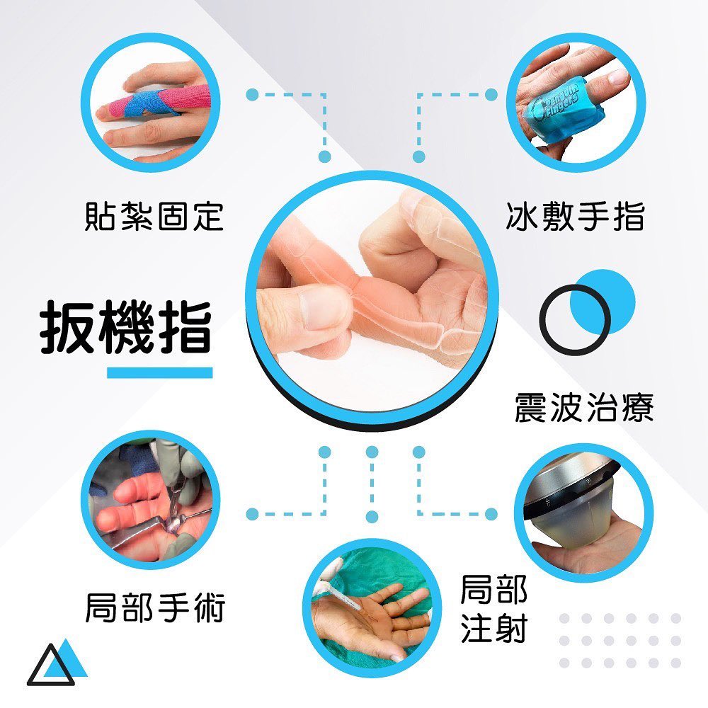 扳機指、手指屈指肌腱狹窄性肌腱鞘炎、手指腫脹疼痛、物理治療、貼紮固定、震波治療、類固醇注射、趙冠博醫師、新店冠新復健科診所