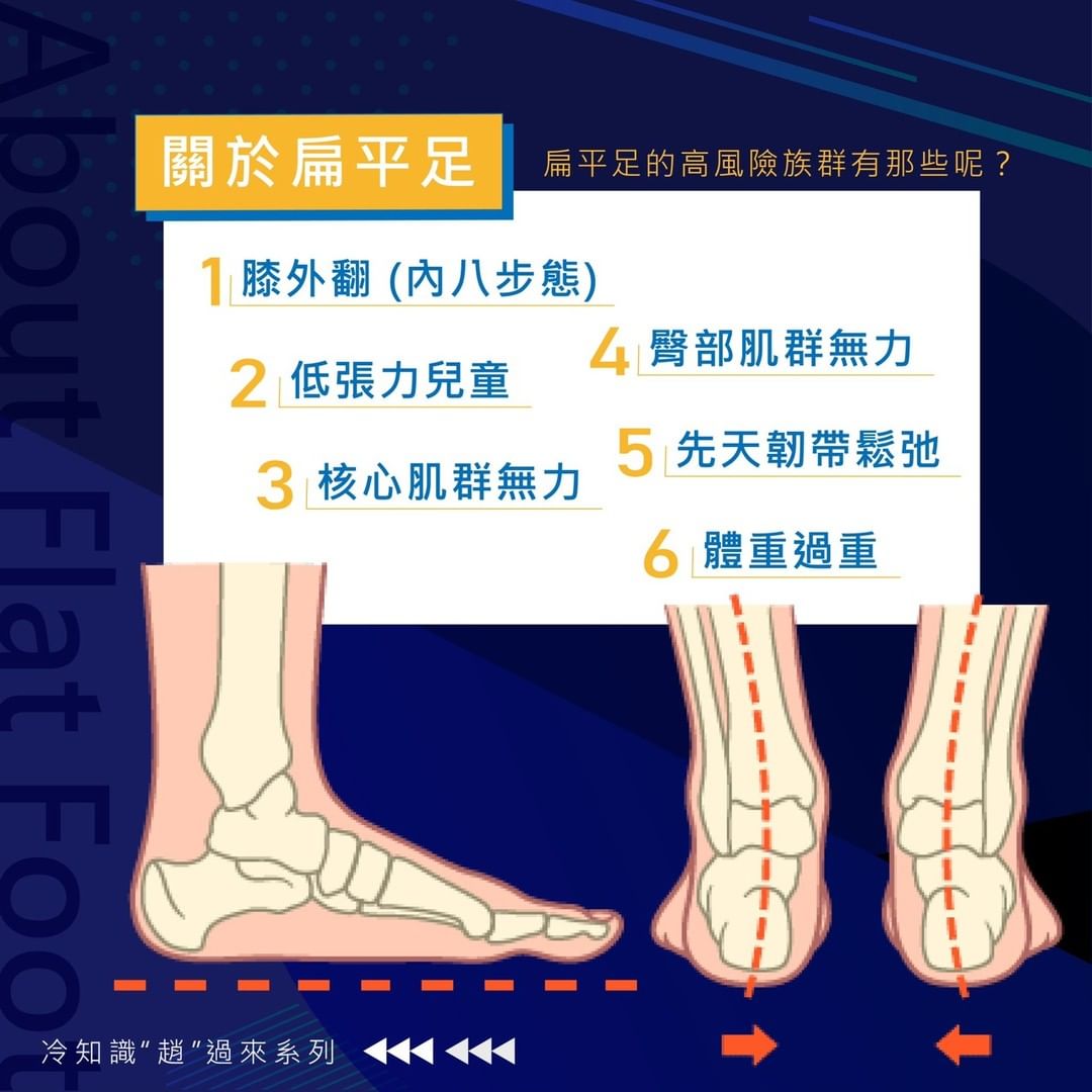 扁平足、足弓、足底筋膜炎、膝外翻、韌帶鬆弛、足部外翻、骨盆歪斜、趙冠博醫師、新店冠新復健科診所